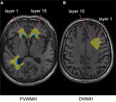 Characterizing the Penumbras of White Matter Hyperintensities and Their Associations With Cognitive Function in Patients With Subcortical Vascular Mild Cognitive Impairment